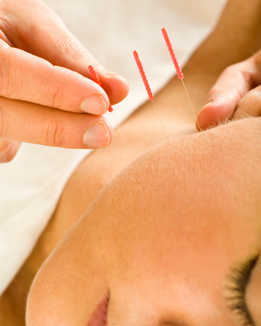 posturalle-serviço-acupuntura